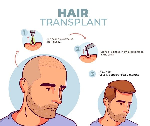 FUE transplant procedure