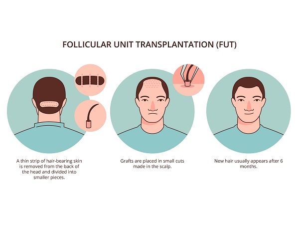FUT hair transplant