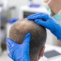 Hair transplant gone wrong