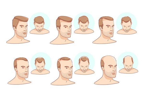 Infographic of examples of the evolution of alopecia in a man