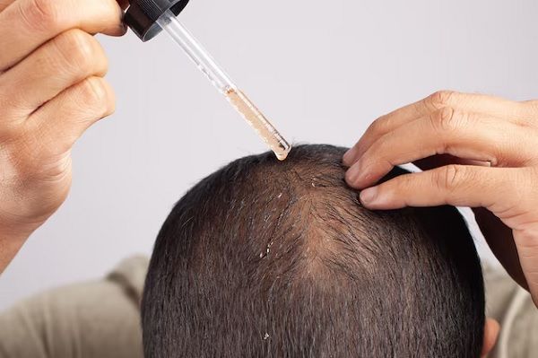 Finasteride for hair loss