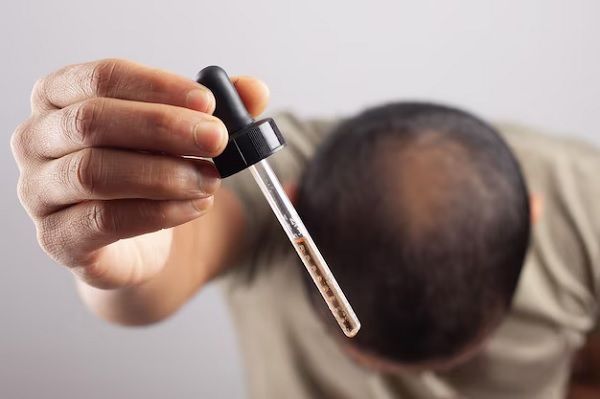 Finasteride for hair loss