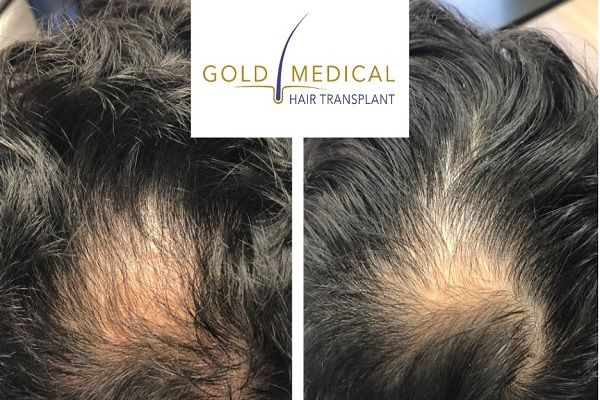 Gold Medical Hair Transplant