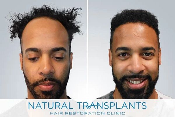 Natural Transplants 1