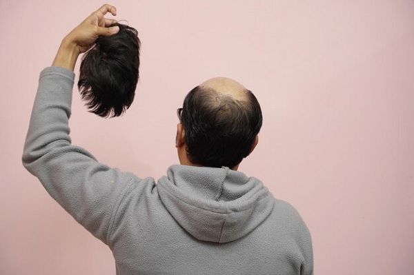 Scarring alopecia