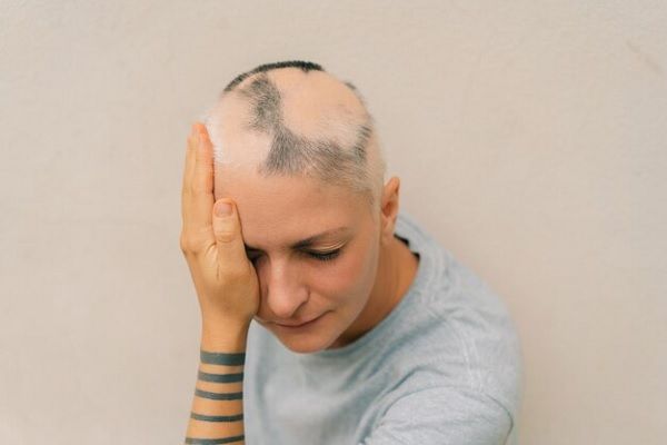 Scarring alopecia