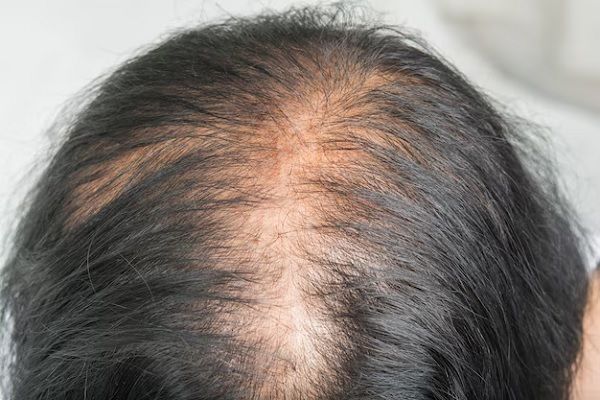 Telogen effluvium