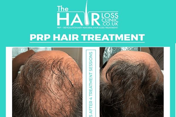 The Hair Loss Clinic Manchester