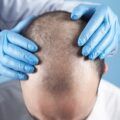 Top 10 hair transplant clinics in Dubai