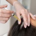 Top 10 hair transplant clinics in Italy