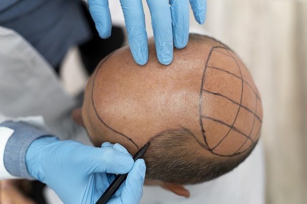 Body hair transplant 1