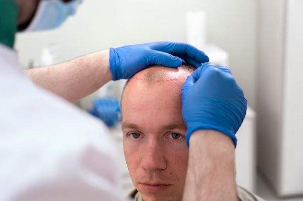 Choi-Implanter-Pen bei Haartransplantation 2