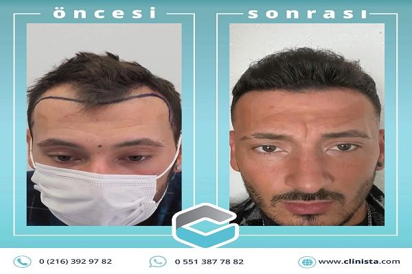 Clinista Hair Transplant Center