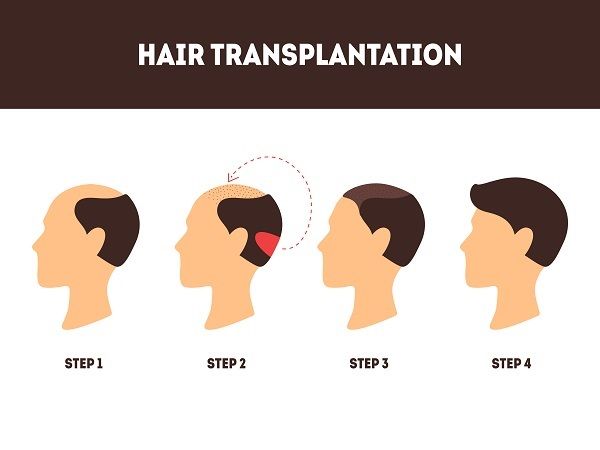DHI Haartransplantation