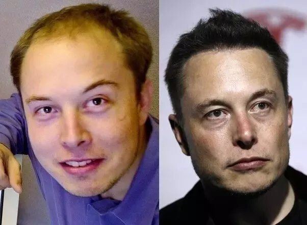 Elon Musk Haartransplantation