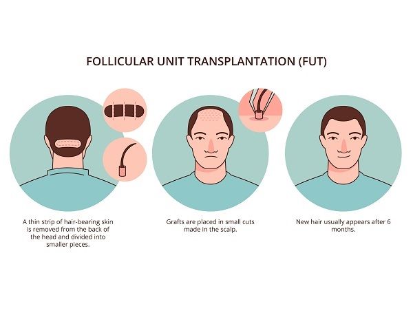 Evolution der Haartransplantation 2