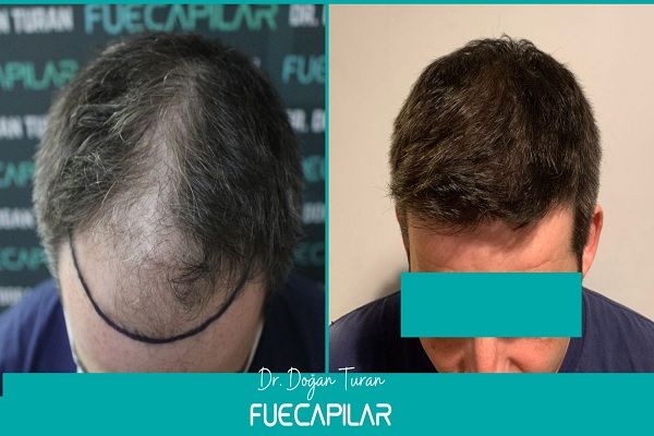 FUECapilar