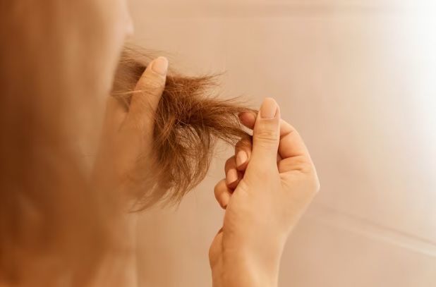 Folliculitis decalvans 1