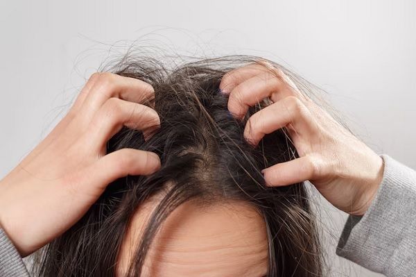 Folliculitis decalvans 2