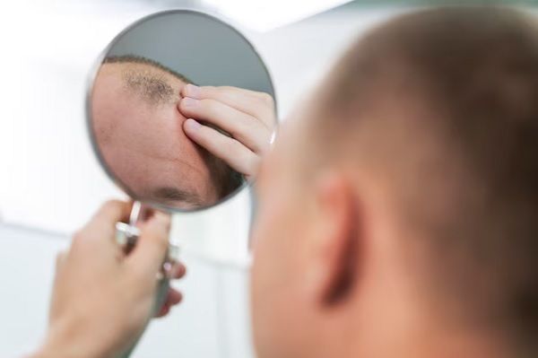 Folliculitis decalvans 3