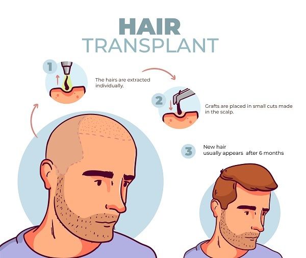 Haartransplantation in Thailand