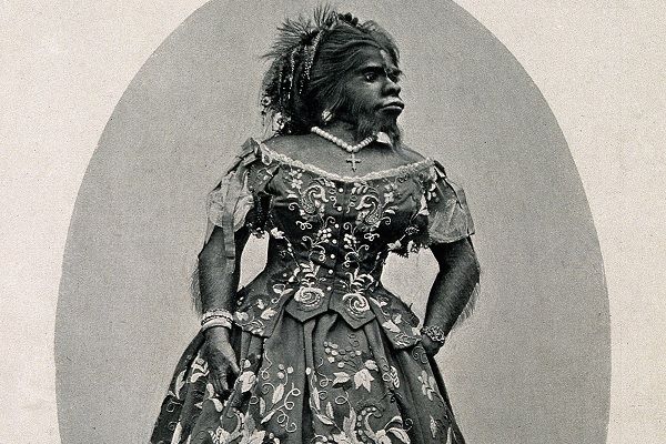 Hypertrichosis