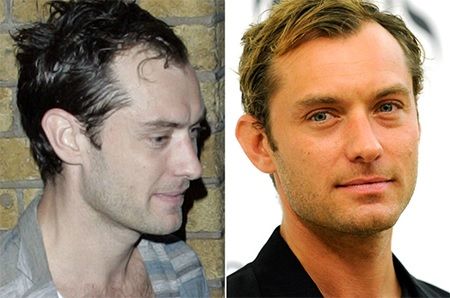 Jude Law Haartransplantation