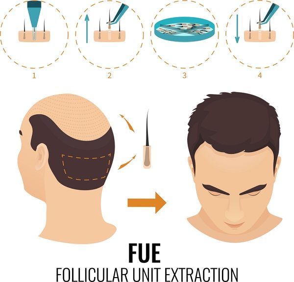 Kann das Tragen einer Mütze Haarausfall verursachen 2