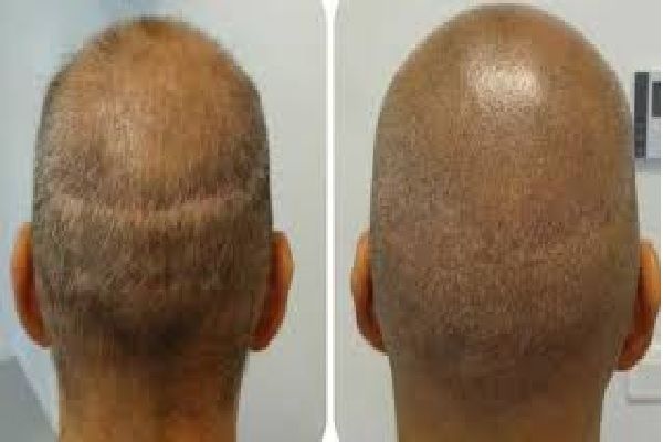 Phuket Hair Loss Clinic 1