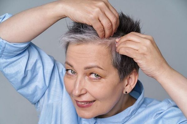Poliosis or white streak in the hair 1