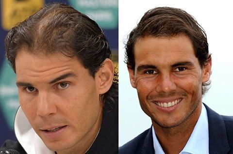 Rafael Nadals Haartransplantation