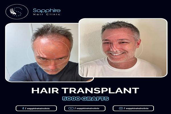 Sapphire Hair Clinic Istanbul