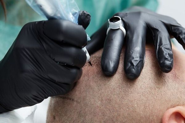Scalp-Mikropigmentation