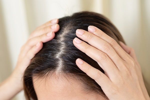 Seborrhoische Dermatitis 1
