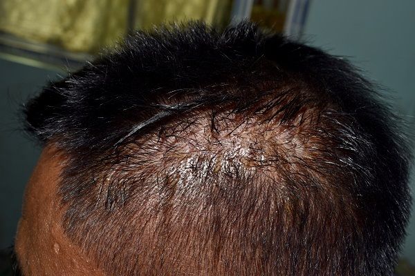 Seborrhoische Dermatitis 3