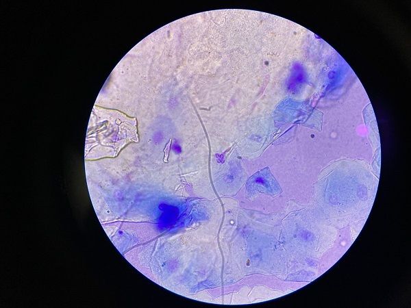 Seborrhoische Dermatitis