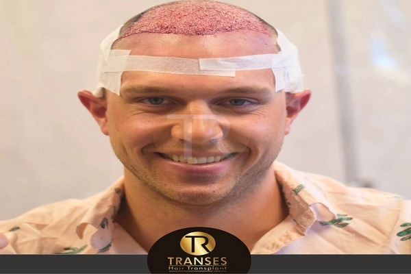 Transes Hair Transplant Center