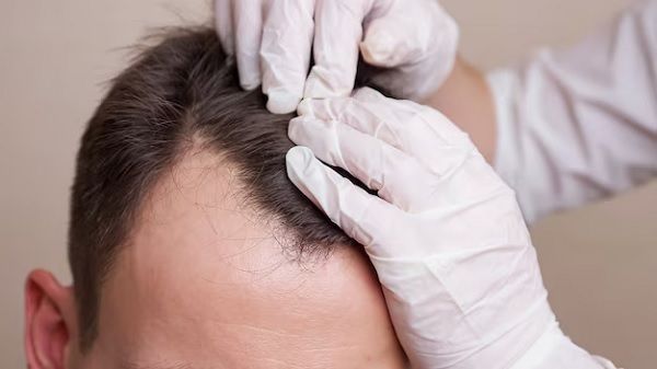 Wie viel Schmerzen verursacht ein Haartransplantat