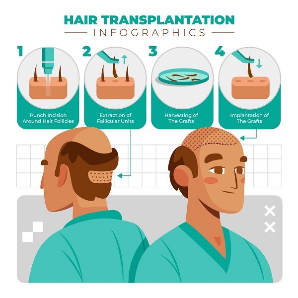 Wie viel kostet eine Haartransplantation in Spanien
