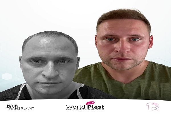 World Plast Hair Istanbul Clinic