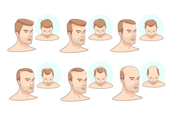 Androgenetische Alopezie