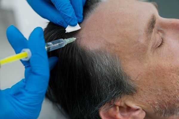 Haarmesotherapie