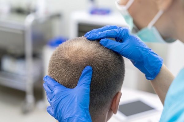 Pickel auf der Kopfhaut nach einer Haartransplantation 3