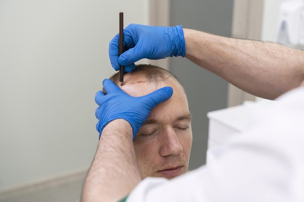 Technical precision in FUE hair transplant hairline creation