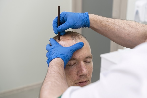 Technische Präzision beim FUE-Haartransplantation Haarlinie Verfahren